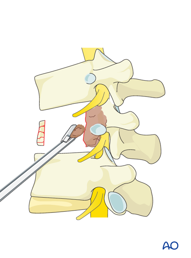 anterior corpectomy and stabilization