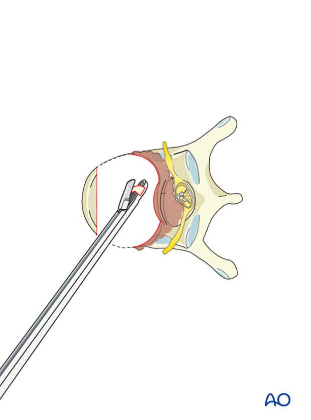 anterior corpectomy and stabilization