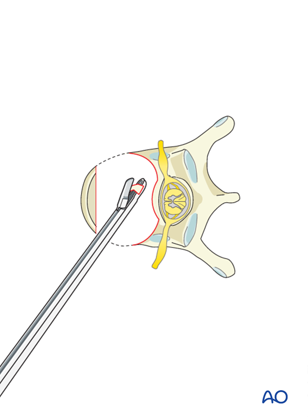 anterior corpectomy and stabilization