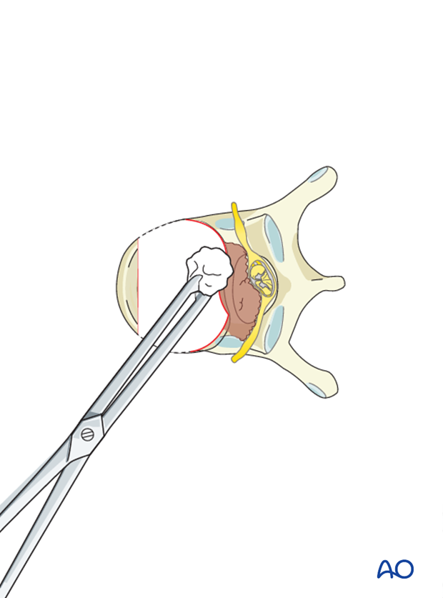 anterior corpectomy and stabilization