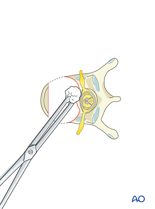anterior corpectomy and stabilization