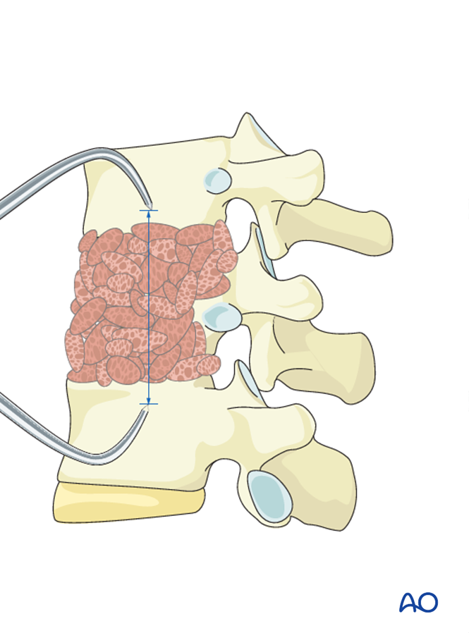 Anterior corpectomy and stabilization for Thoracolumbar, unstable, high ...