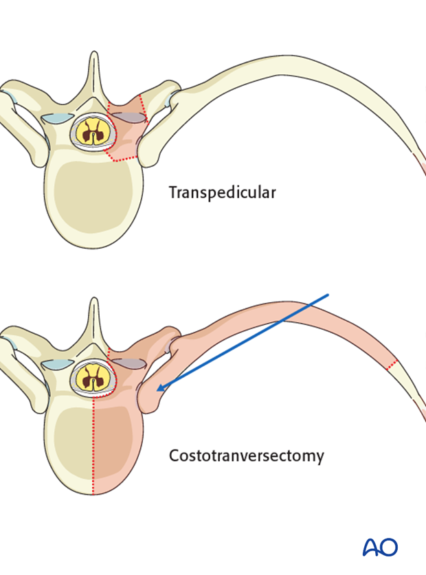 posterior decompression and stabilization with corpectomy