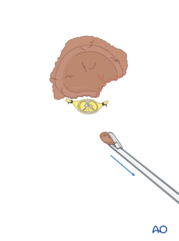 posterior decompression and stabilization with corpectomy