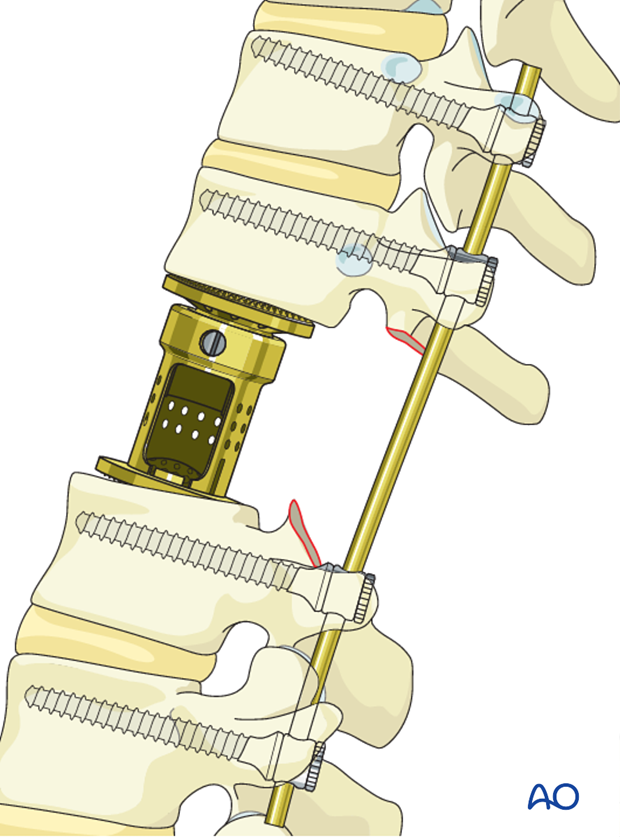 posterior decompression and stabilization with corpectomy