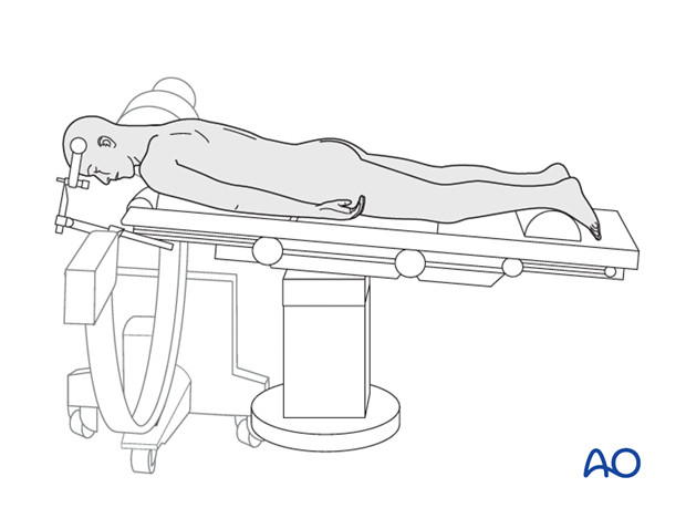 Patient positioned on a radiolucent table in prone position with image intensifier