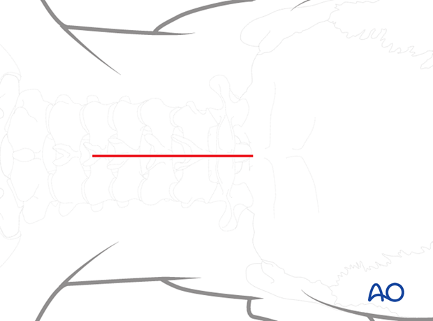 Marking of incision for posterior access to the occipitocervical spine