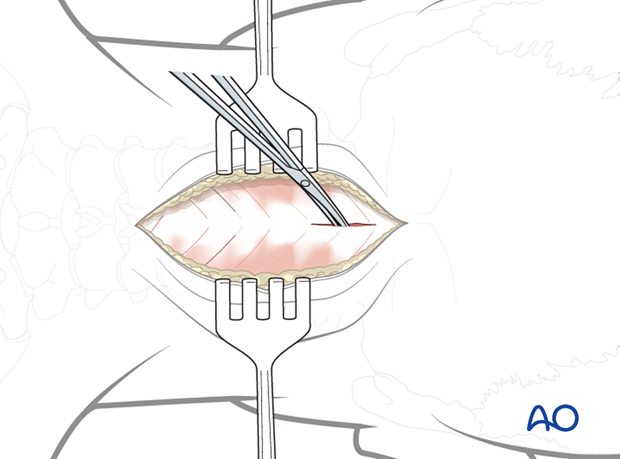 Dissection during posterior access to the occipitocervical spine