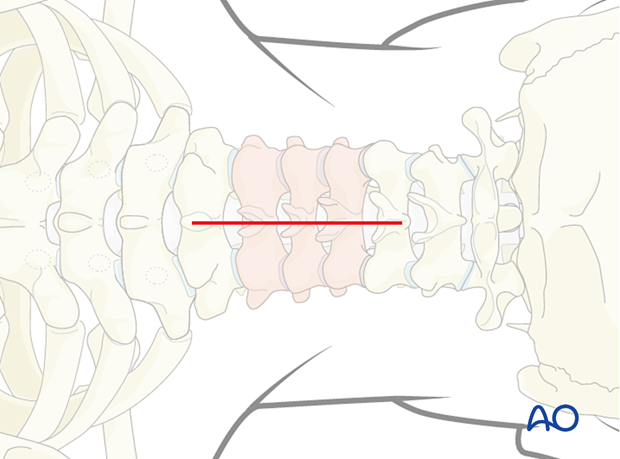 Midline skin incision during posterior access to the cervical spine