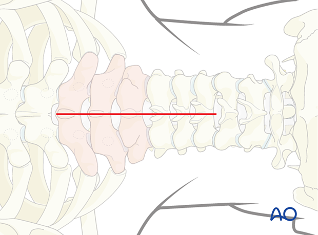 Lines of a planned chevron olecranon osteotomy