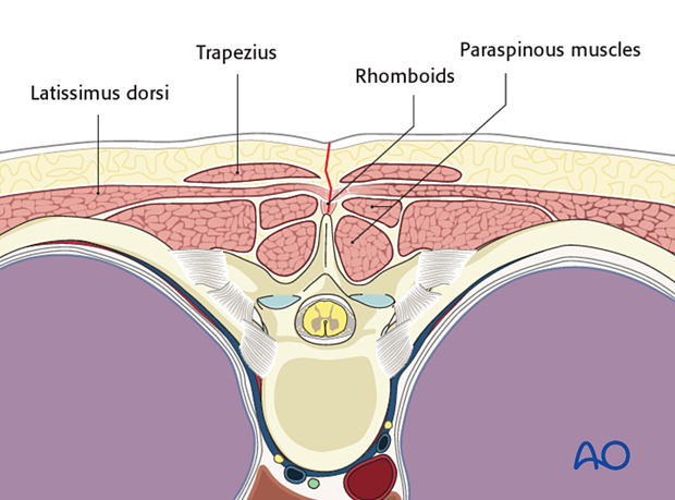 Dissection of posterior midline approach