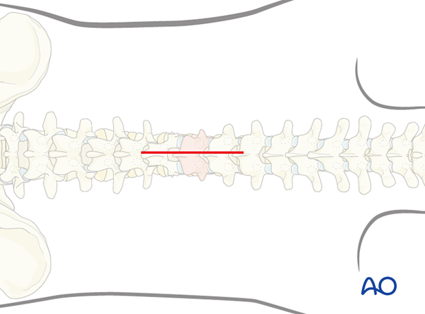 Midline skin incision during posterior midline access to the thoracolumbar spine