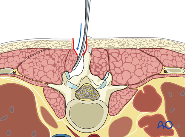 Elevation of paraspinal muscles during posterior midline access to the thoracolumbar spine