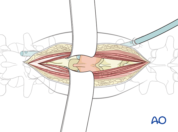 Insertion of drain during posterior midline access to the thoracolumbar spine