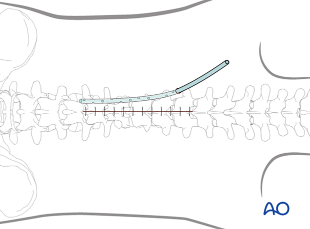 The subcutaneous layers and skin are sutured during posterior midline access to the thoracolumbar spine