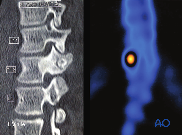 Osteoid osteoma radiology