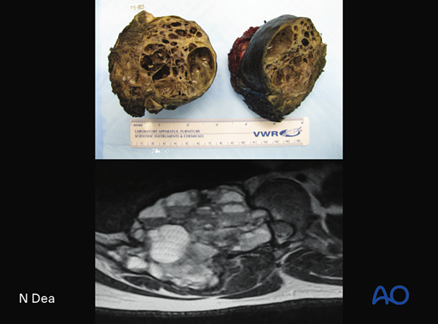 Aneurysmal bone cyst