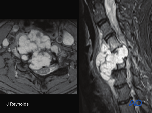 Chondrosarcoma is often a large, lytic mass with a chondroid matrix.