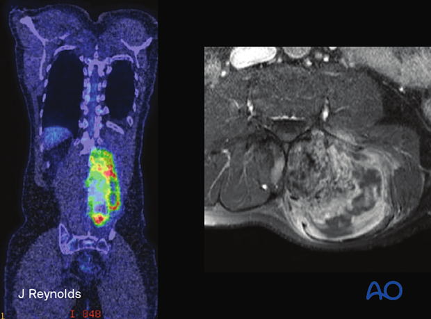 The most common clinical presentation of osteosarcoma is the insidious onset of nocturnal back pain