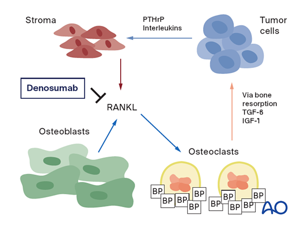 Using Denosumab against giant cell tumors