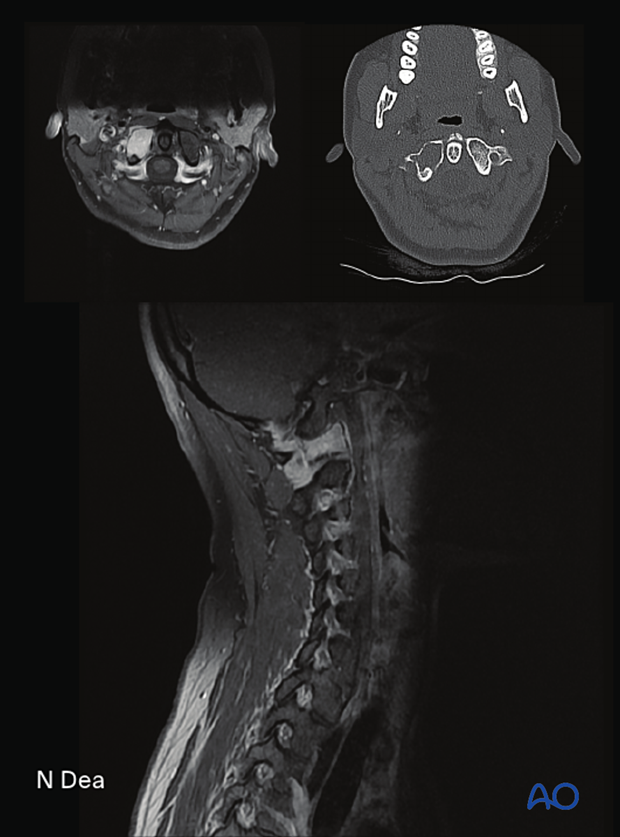 CT and MRI imaging of right C1 lateral mass tumor