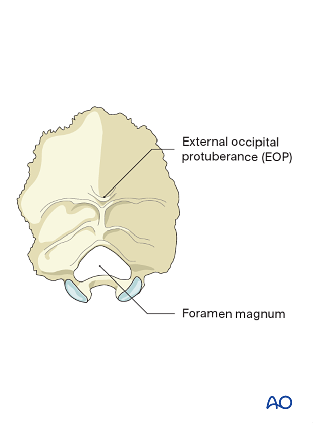 The external occipital protuberance and foramen magnum are landmarks during intralesional resection C0 to C2