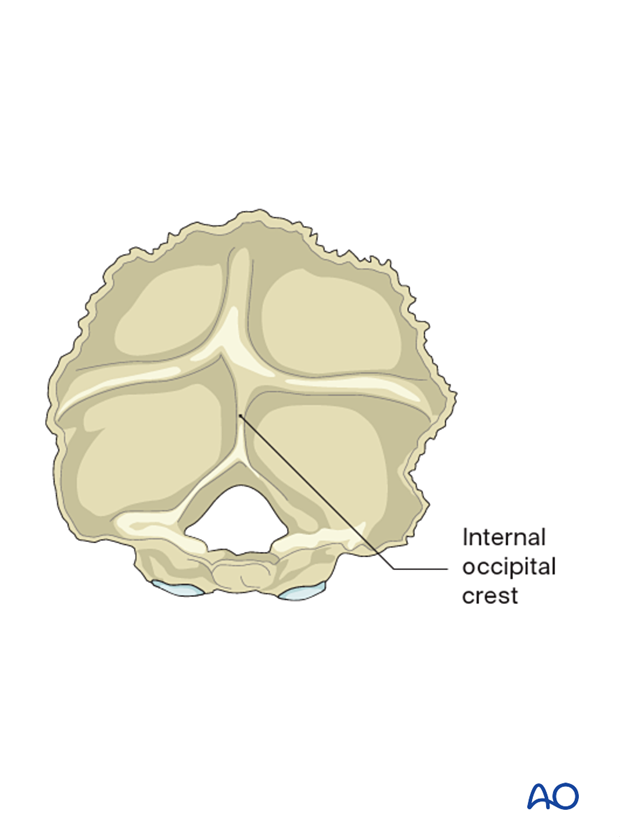 The internal occipital crest is a landmark during instrumentation of the occiput