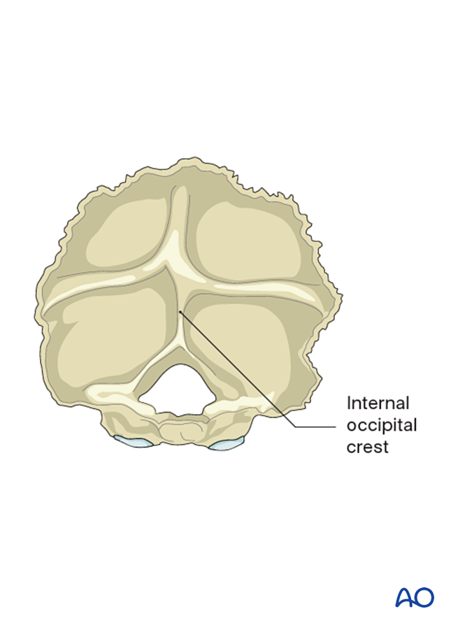 Occipitocervical fusion IIC for Region II Type C: Translation injury of ...