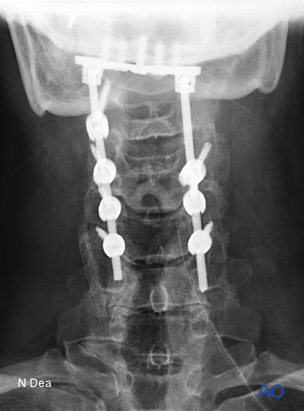 Intraoperative image during intralesional resection C0 to C2 to check reduction, position, and length of screws, and overall coronal and sagittal spinal alignment 