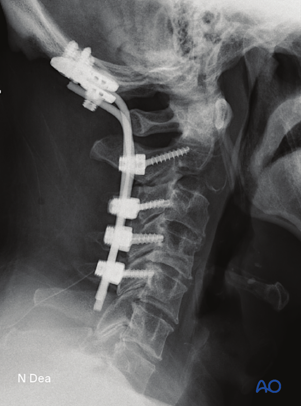 Intraoperative image (lateral view) during intralesional resection C0 to C2 to check reduction, position, and length of screws, and overall coronal and sagittal spinal alignment 