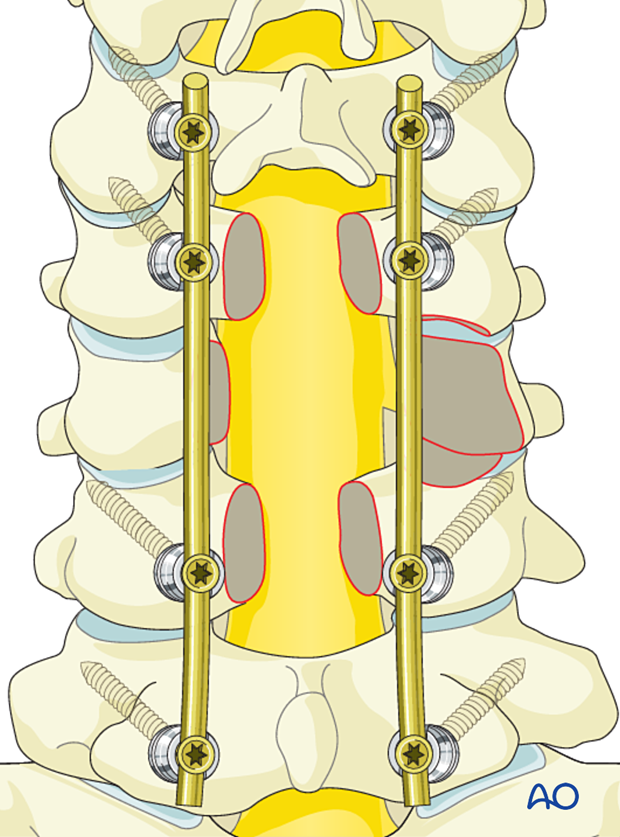 Reconstruction strategy of intralesional resection C3 to C7