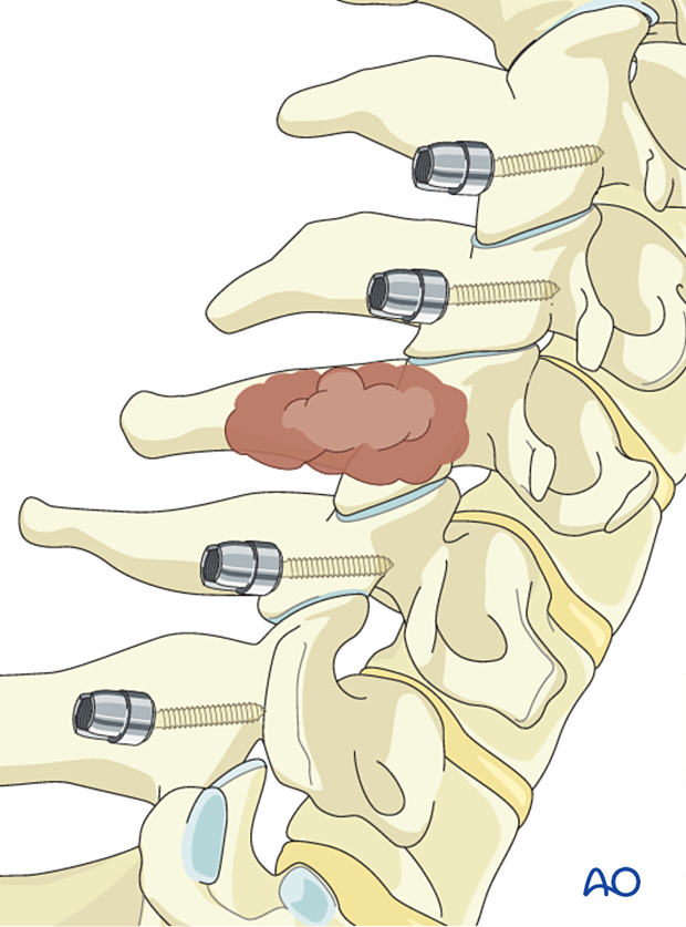 Screw insertion during intralesional resection C3 to C7