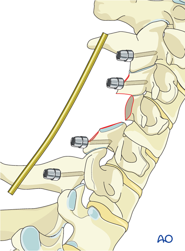 Rod contouring and insertion during intralesional resection C3 to C7