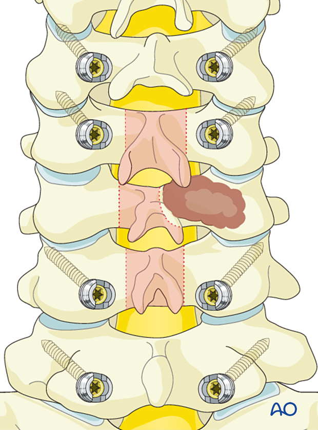 56b P310 Intralesional resection C3 to C7