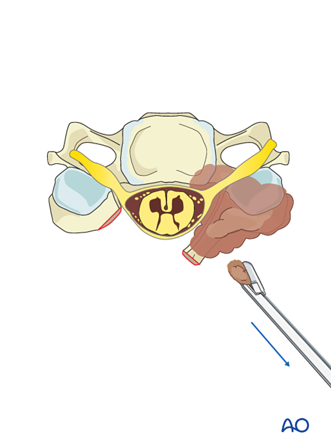 Intralesional resection (C3 to C7) for Benign cervical tumors