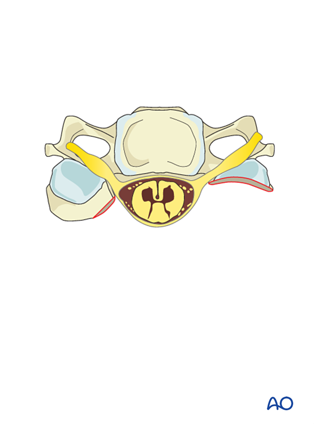 Tumor is entirely resected during intralesional resection C3 to C7