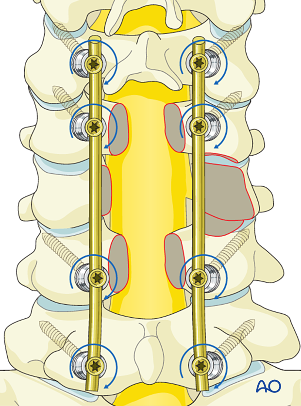 Securing rods during intralesional resection C3 to C7