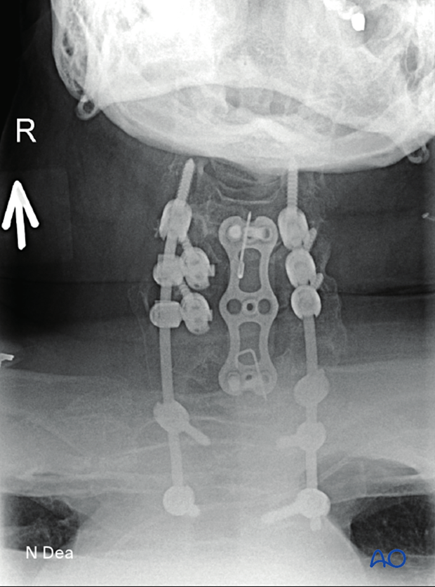 Intraoperative AP image after intralesional resection C3 to C7