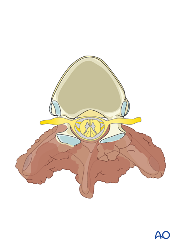 Tumor involving the posterior element of a vertebra bilaterally