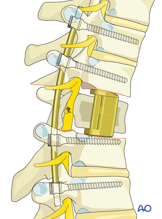 Vertebral body reconstruction during intralesional resection T1 to T12