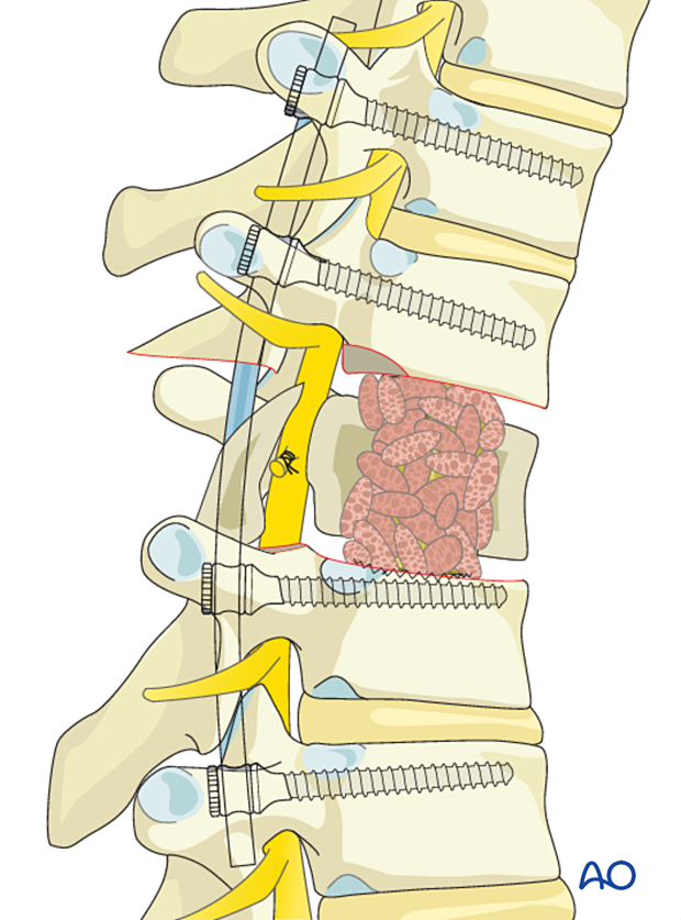 Bone grafting during intralesional resection T1 to T12