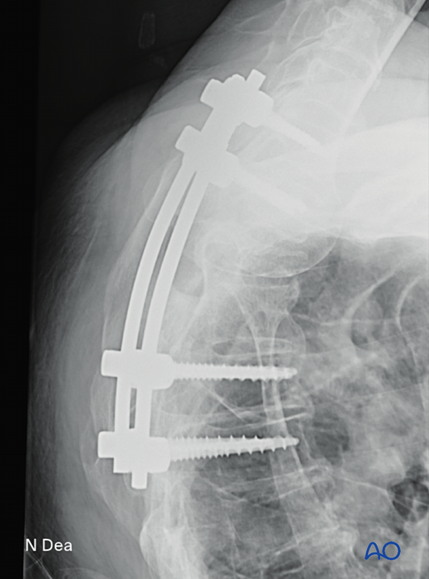 Intraoperative image (lateral view) after intralesional resection T1 to T12 showing position of screws and rods