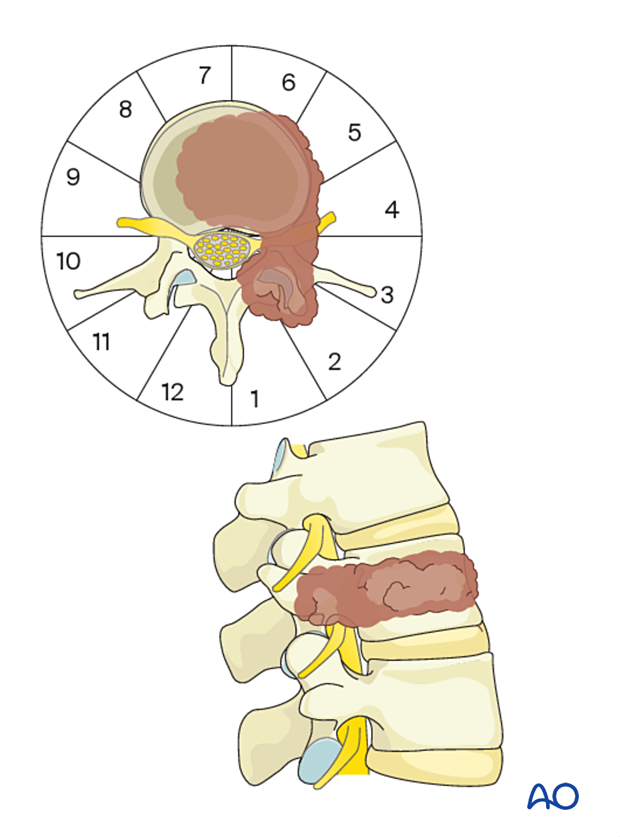 L2 tumor located in segments 1–8 of the WBB classification