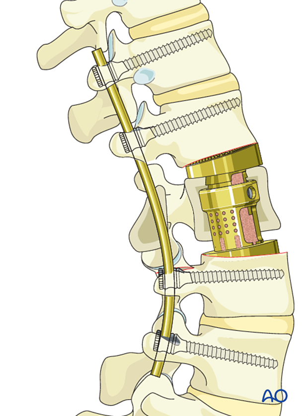 Vertebral body reconstruction during intralesional resection L1 to L5