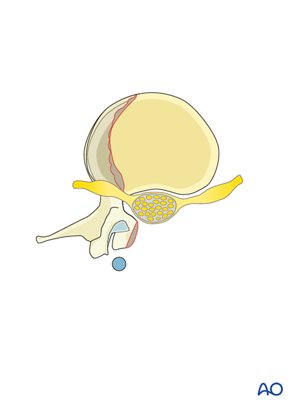 The corpectomy is completed during PMMA application for vertebral body reconstruction