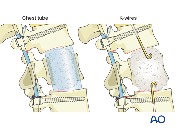 Using PMMA to fill the defect during vertebral body reconstruction.