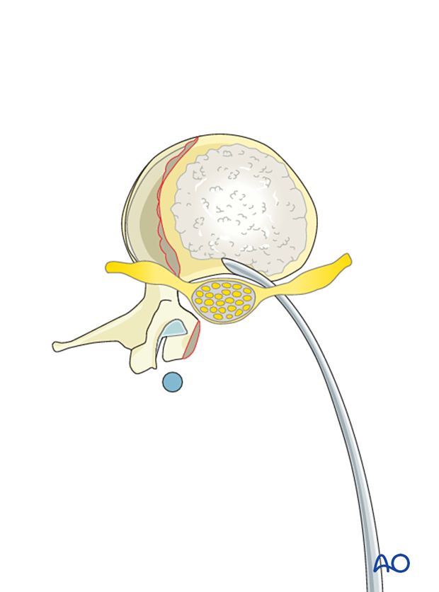 PMMA is irrigated and continuously molded to keep it in place during vertebral body reconstruction.