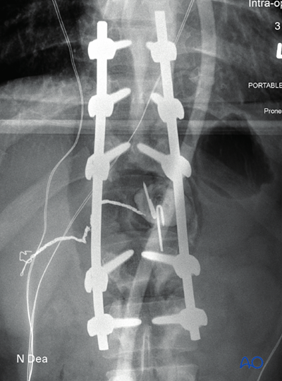 Intralesional resection (L1 to L5) for Benign lumbar tumors