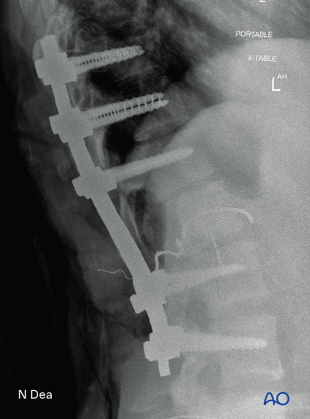 Intraoperative lateral image after intralesional resection showing position of screws and rods