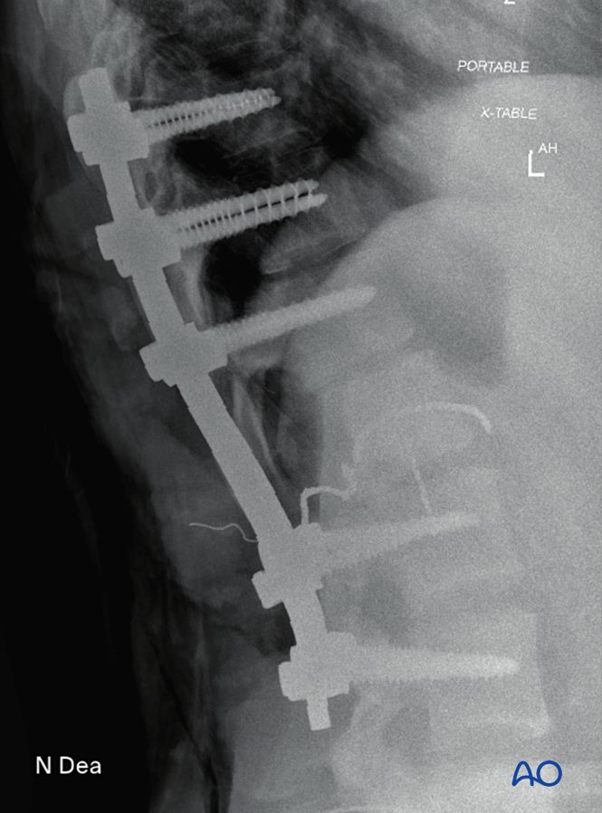 Intralesional resection (L1 to L5) for Benign lumbar tumors